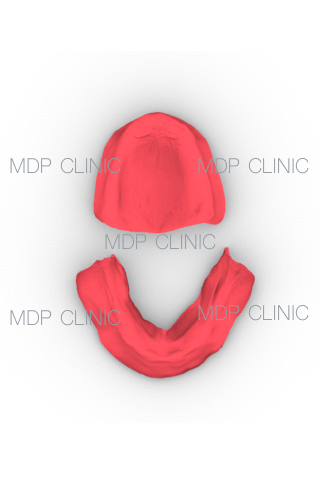 14 Elementi Dentari su 6 Impianti in Arcata Superiore. 14 Elementi Dentari su altrettanti 6 Impianti in Arcata Inferiore